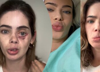 Câncer bucal avança de forma silenciosa no Brasil e diagnóstico tardio ainda causa mutilações e impacto social